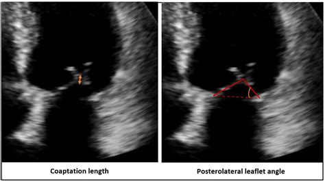 Figure 1 From Multimodality Imaging In Secondary Mitral Regurgitation