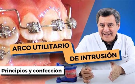 Como Crear Un Arco De Intrusi N En Ortodoncia Para Lograr Odonto Science