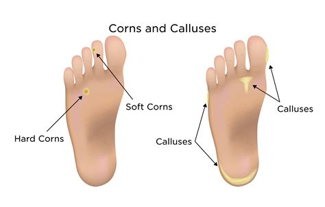 Infected Callus On Foot Treatment Top Sellers | emergencydentistry.com