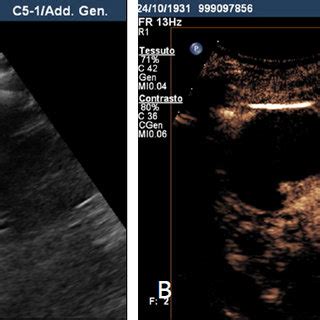 Bosniak 2F cyst. A: Grey scale sonography shows in the mid portion of ...