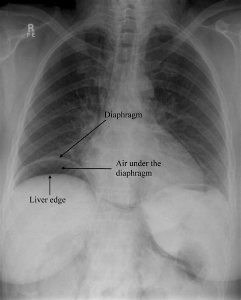 Pneumoperitoneum Stepwards