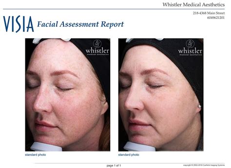 Laser And BBL Before And After Gallery - Whistler Medical Aesthetics