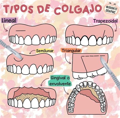 Tipos De Colgajo Escuela De Higiene Dental Odontolog A Higiene