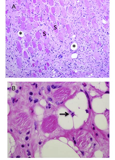 Well Differentiated Liposarcoma Atypical Lipomatous Tumour A Orbital