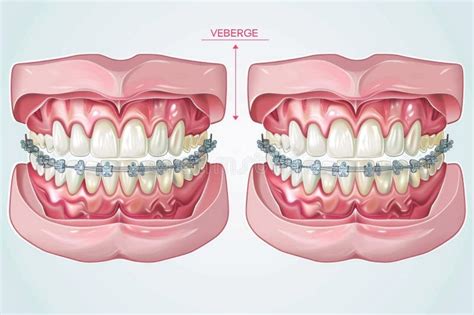 Close Up Of Uneven Teeth With Orthodontic Braces For Correction On A