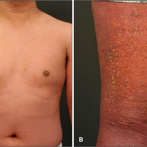 A Generalized Symmetrical Erythema With Overlying Pustules On The