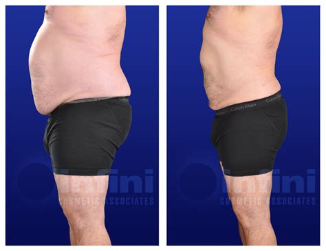 Comb Over The Liposuction On Inner Thighs Before And After