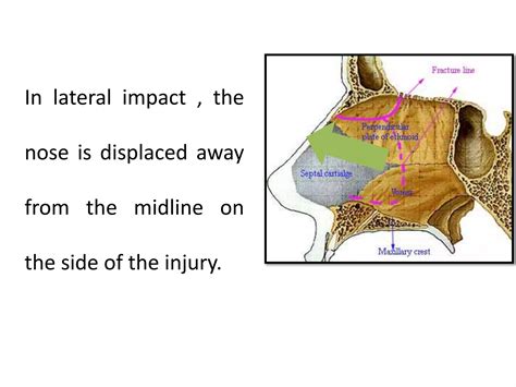 Nasal Fracture Ppt