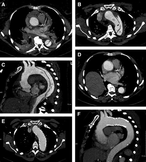 Axial A And B And Sagittal C Ct Images Of A Retrograde Type A