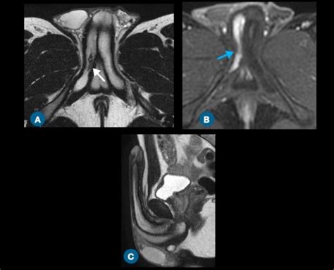 A Axial T2 Weighted MR Image Shows A Focal Lesion White Arrow In