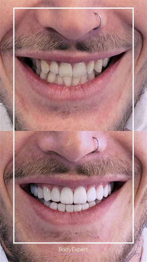 Before After Dental Veneers In Turkey With Bodyexpert Facettes