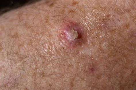 How Dangerous Is A Squamous Cell Carcinoma Manhattan Dermatology