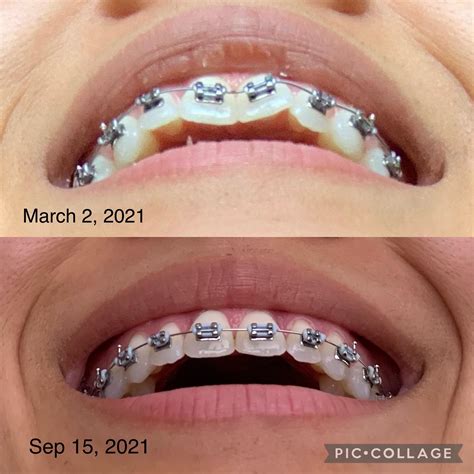 6 Months Progress Braces