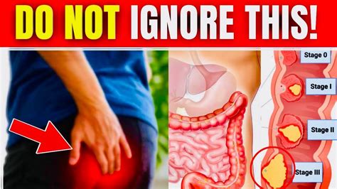 8 EARLY Warning Signs Of Colon Cancer You Should NOT IGNORE Colon