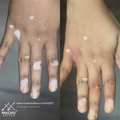 Latest Vitiligo Treatment 2024 Lok - Karen Madelina