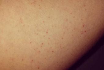 Is petechiae harmful?