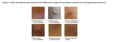 La Mpox Variole Simienne Est Elle Disparue PVSQ