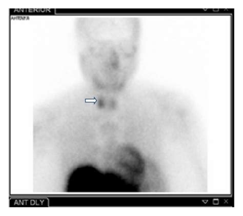 Radionuclide Parathyroid Imaging Using Technetium Tc 99m Sestamibi