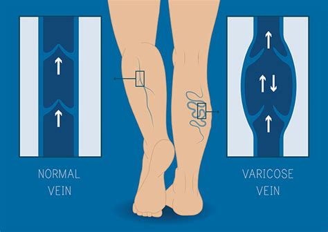 Chronic Venous Insufficiency | Cardiovascular Institute of the Shoals