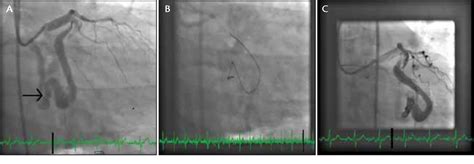 Figure 2 From Treating Coronary Artery Fistulas And Pulmonary Avms