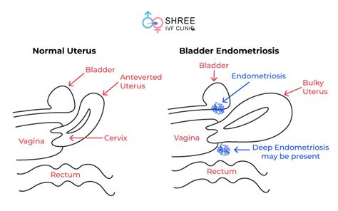 Bladder Endometriosis | Endometriosis Clinic In Mumbai