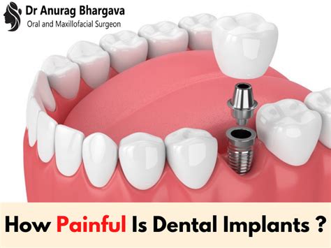 How Painful Is Dental Implants Procedure Know From The Top Dental Surgeon Dr Anurag Bhargava