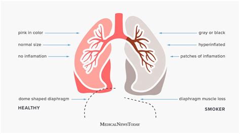 Smoker S Lungs Vs Healthy Lungs Facts Pictures And More