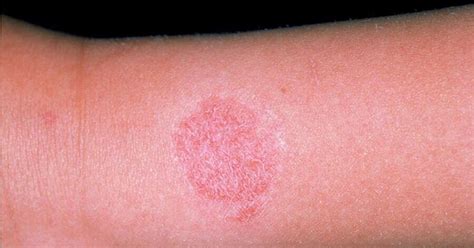 Part 2 Irritant Contact Dermatitis Beautybible