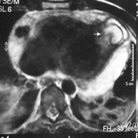 Magnetic Resonance Imaging Of Cardiac Hydatid Cyst Arrow Download Scientific Diagram