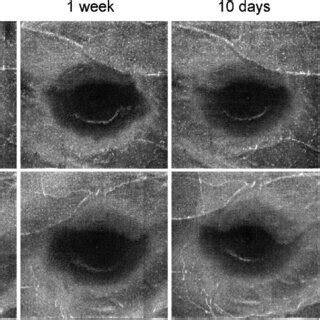 Multimodal Imaging In Case 4 Structural Optical Coherence Tomography