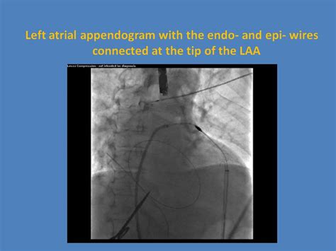 Percutaneous Left Atrial Appendage Ligation With Lariat 严道医声网