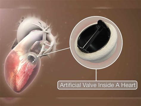 First Made In India 3 D Printed Heart Valve Developed In Chennai