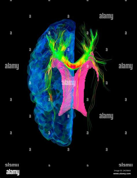 Las Fibras Del Cerebro 3d De Imágenes De Tensor De Difusión Dti Imágenes Por Resonancia