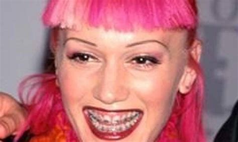 10 Famous Faces Who Wore Adult Braces Fame Focus