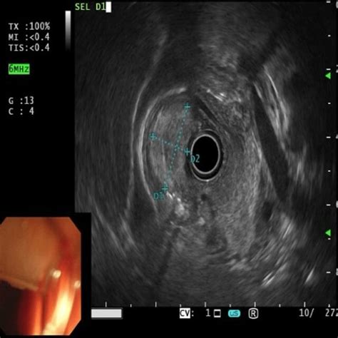 Endoscopic Ultrasound Eus Showing A Mass Originated From 2nd Mucosal Download Scientific