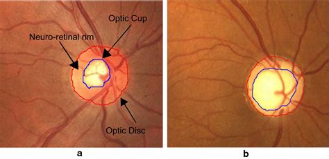 Cnns For Automatic Glaucoma Assessment Using Fundus Images An