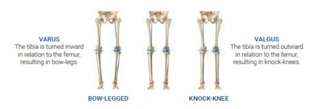 KINEMATICALLY ALIGNED TOTAL KNEE REPLACEMENT SURGERY USING COMPUTER