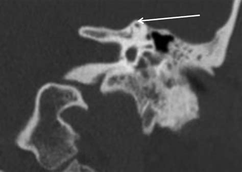 Prevalence Of Superior Semicircular Canal Dehiscence On High Resolution Ct Imaging In Patients