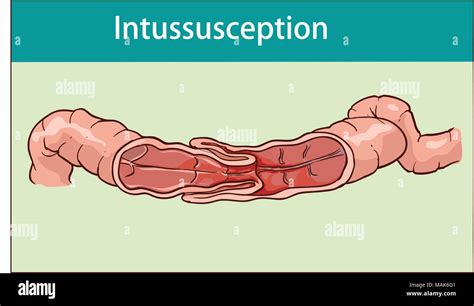 Vector Illustration Of Intussusception Of Intestine Obstruction Stock