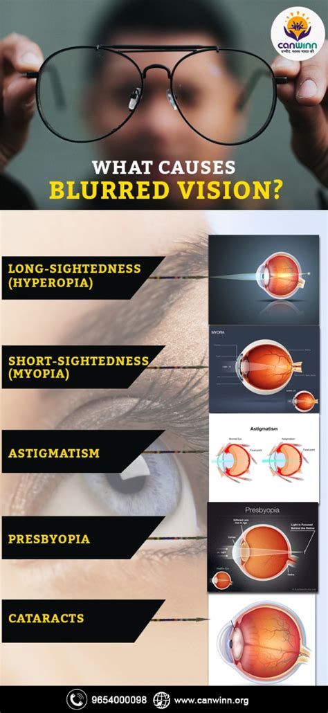 What causes blurred vision? - Canwinn