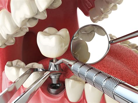 4 beneficios de los implantes dentales C M Odontología Clínica