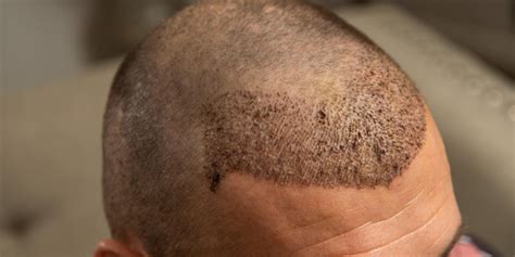 Hair Transplant Before After Turkey Asli Tarcan Clinic