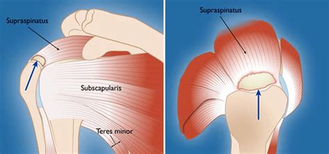 Rotator Cuff Tear Treatment Singapore Arthroscopic Surgeon