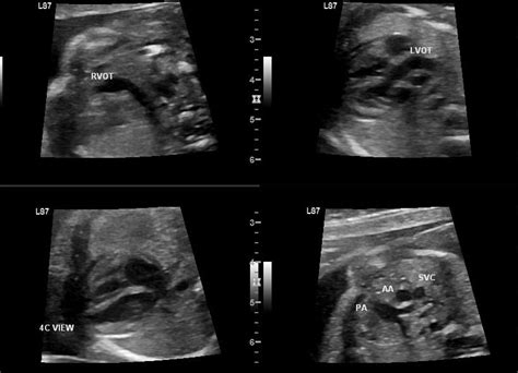 Fetal Heart Ultrasound