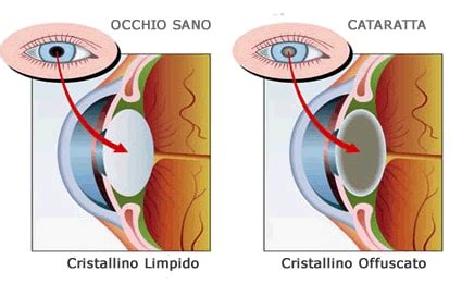 Cataratta Terapia Intervento E Prevenzione