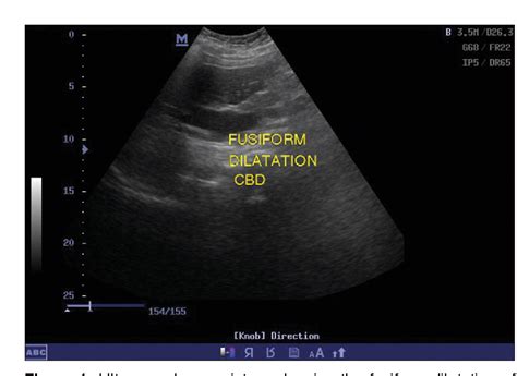 Figure 1 From Management Of Adult Choledochal Cyst Coexisting With Gallbladder Carcinoma A Case