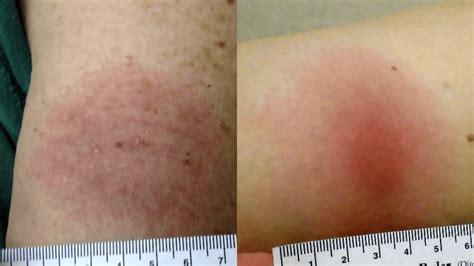 The Myth Of The Bullseye Why Recognizing The Spectrum Of Lyme Disease Rashes Is Critical For