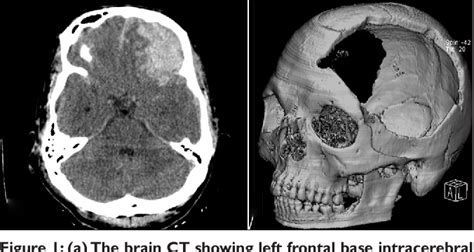 Figure 1 From Expanding Contralateral Epidural Hematoma Causing Acute