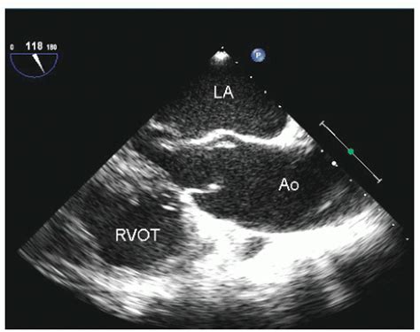 Diseases Of The Aorta Thoracic Key