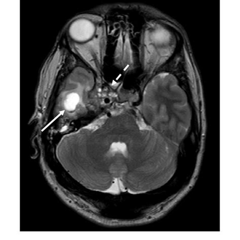 Cavernous Sinus Mri Brain